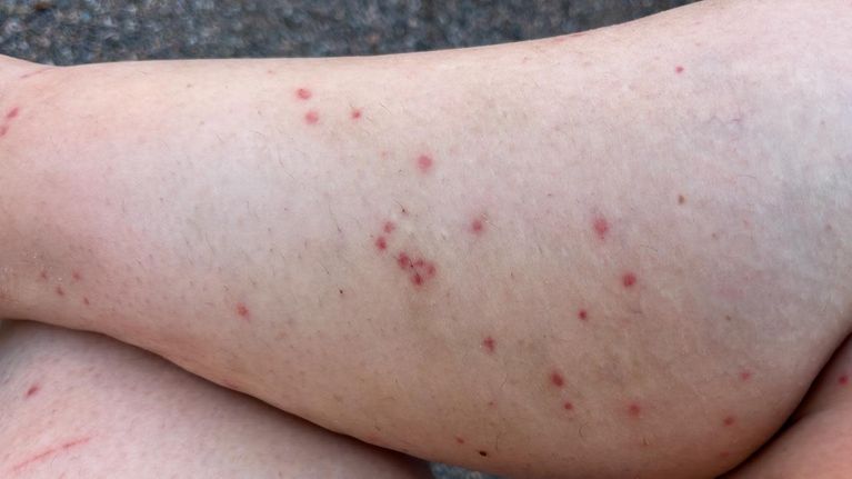 Lähikuva pohkeesta, jossa on kymmeniä punaisia mäkäräisen puremia.