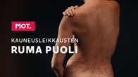 Kauneusleikkausten ruma puoli -jakson julistekuva. Kuvassa henkilön selkään on piirretty viivoja.