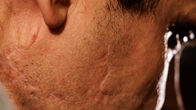 Lähikuvassa näkyy Karin niska ja kaula, joissa on arpia leikkausten jäljiltä.