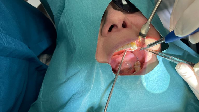 Hammasimplantin operointia.