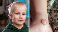 Ilmari Honkanen toisella puolella kuvaa ja toisella ilmarin jalka jossa iso rakkula.