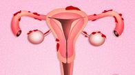 Piirretty kuva kohdusta ja endometrioosista