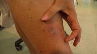 Lymen borrelioosi kehittää noin viiden sentin iho-oireen puremakohdan ympärille.