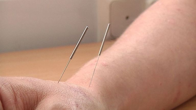 Kaksi akupuntioneulaa kämmensyrjässä.