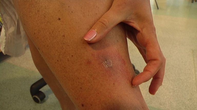 Lymen borrelioosi kehittää noin viiden sentin iho-oireen puremakohdan ympärille.
