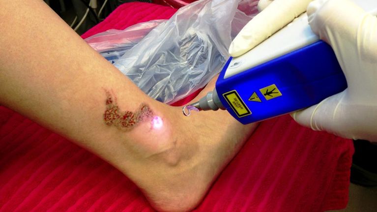 Laserin pulssi kohdistuu tatuoinnin väripigmenttiin, joka hajoaa mikroskooppisiin osiin.