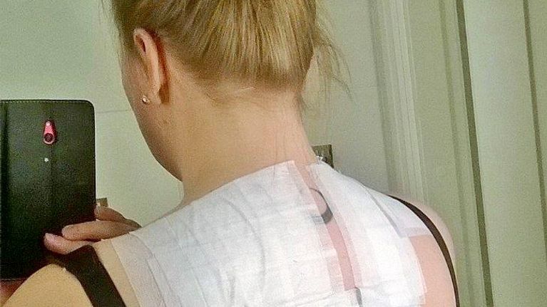 Kati Kristiina Mouhulla testataan, mille kaikille aineille hän on herkistynyt tai allergisoitunut. 