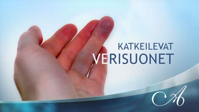 Katkeilevat verisuonet kämmenissä – Omalääkäri – yle.fi