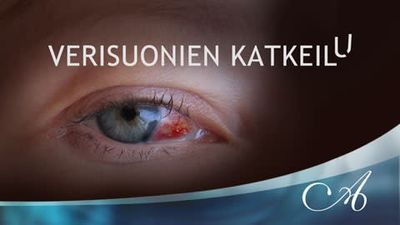 Katkeilevat verisuonet silmissä – Omalääkäri – yle.fi